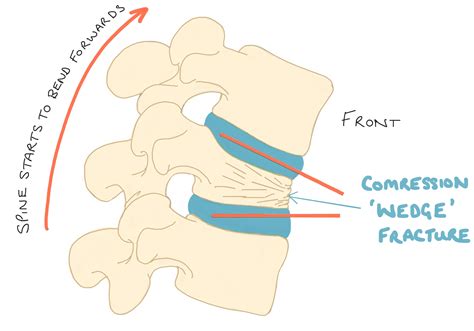 management of wedge compression fracture